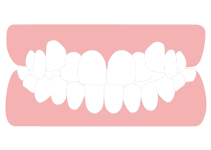 軽度の乱杭歯